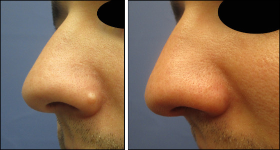 Chicago mole removal shave no scarring